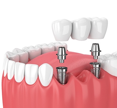 An implant dental bridge in Landrum