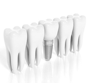 dental implant with crown between several natural teeth