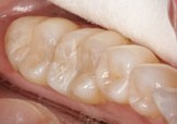 Tooth-colored fillings after