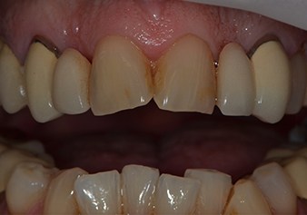 Closeup of discolored and damaged front teeth