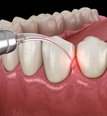 a 3D depiction of soft-tissue laser dentistry treating gum tissue