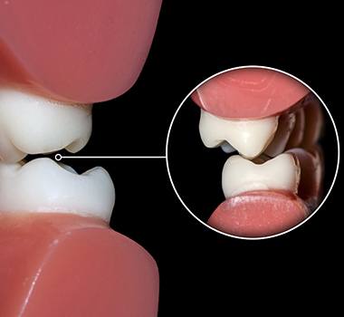 model of a mouth showing teeth grinding at night