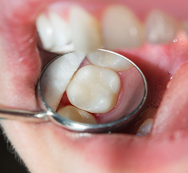 Closeup of repaired tooth