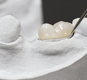 A porcelain dental crown placed on a plaster model