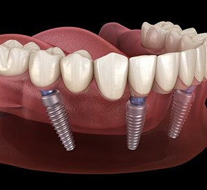 implant denture on bottom arch