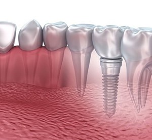 dental implant post with crown on the bottom jaw 