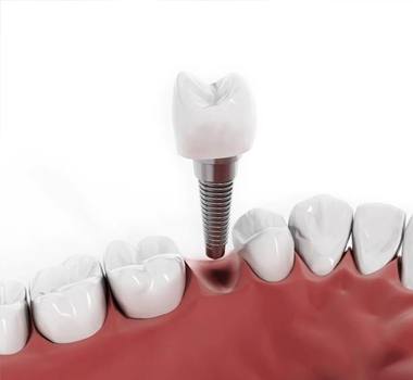 dental implant post with crown being placed into the jaw