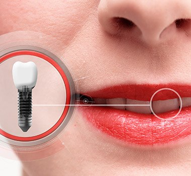 close-up of a person smiling with a dental implant crown