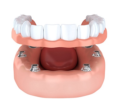 Three-dimensional model of implant-retained full dentures