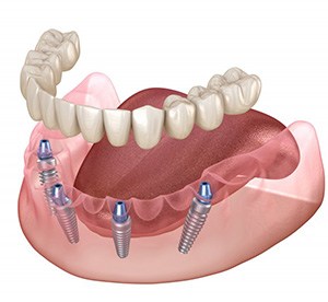 Illustration of all-on-4 denture