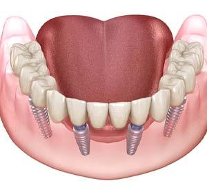 Digital model of implant denture