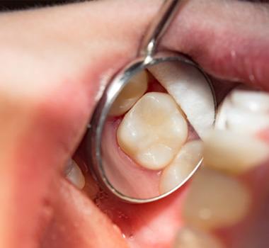 Using dental mirror to examine teeth after placing tooth-colored fillings in Landrum, SC