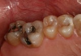 Two teeth with metal fillings