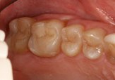Two teeth with natural-looking fillings