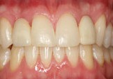 Closed bite after orthodontic treatment