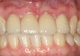 Closeup of repaired front teeth