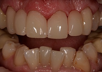 Closeup of flawlessly repaired smile