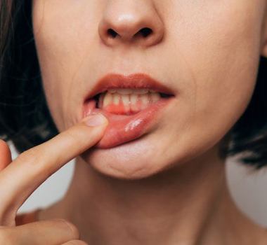 Lady shows inflamed gum tissue