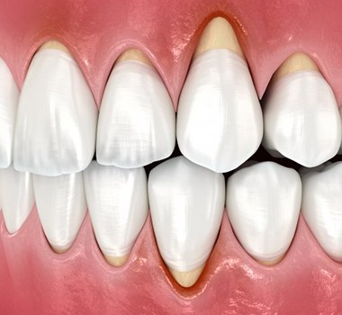 Illustration of receded gumline
