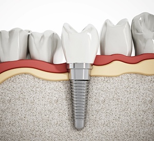 3D illustration of a dental implant that replaced a single tooth