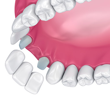 Animation of dentla bridge placement