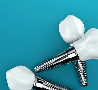 Animation of implant supported dental crowns