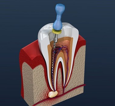 diagram of root canal therapy