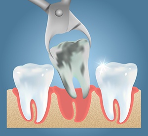 Forceps extracting a damaged tooth between two healthy teeth 