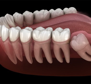 Digital illustration of impacted wisdom tooth 