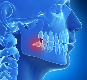 Illustration of impacted wisdom tooth in Landrum, SC