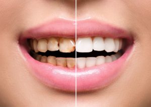 a before and after of a smile treated with cosmetic dentistry