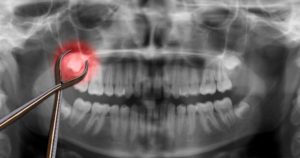 X-ray image with wisdom tooth highlighted red
