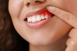 Nose to chin view of woman pulling back lip to reveal swollen gums