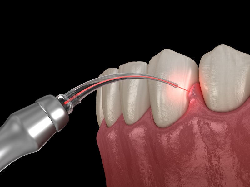 A 3D illustration of a soft tissue laser used on a patient’s gums