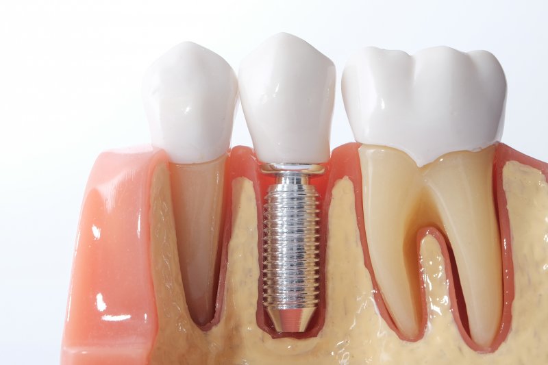 mouth mold with a single dental implant