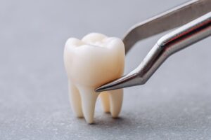 Extracted tooth in dental forceps 