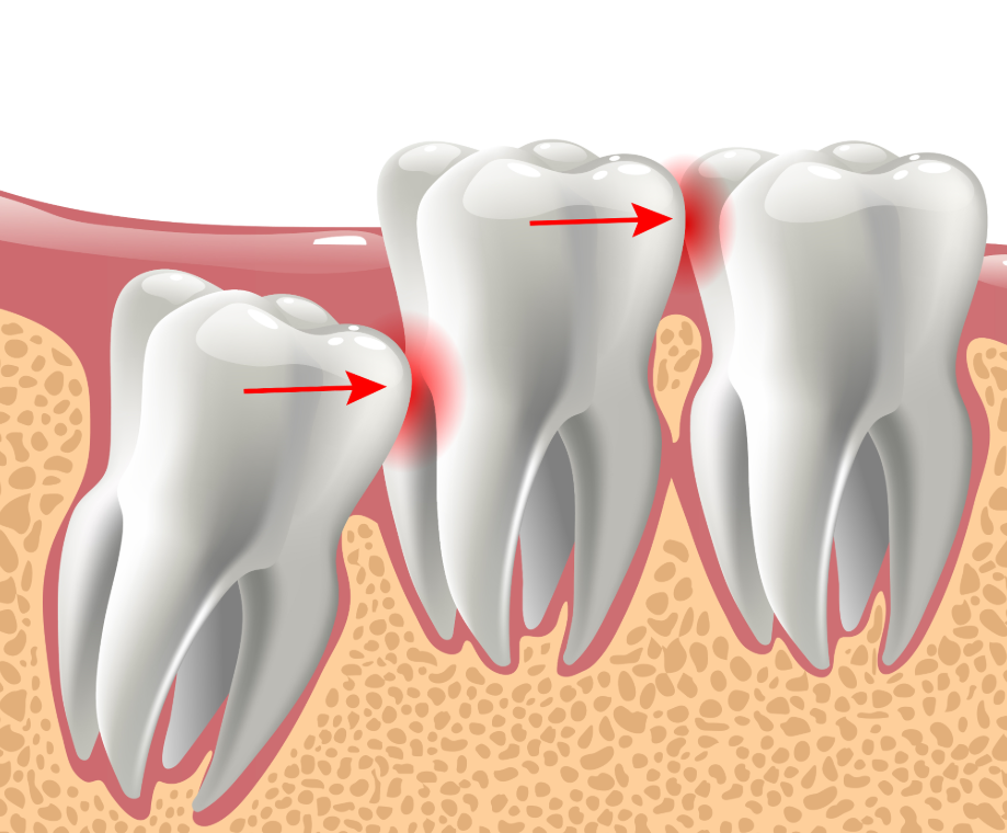 Illustrated cross section of wisdom tooth