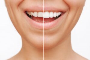 Woman’s before and after fixing her small teeth